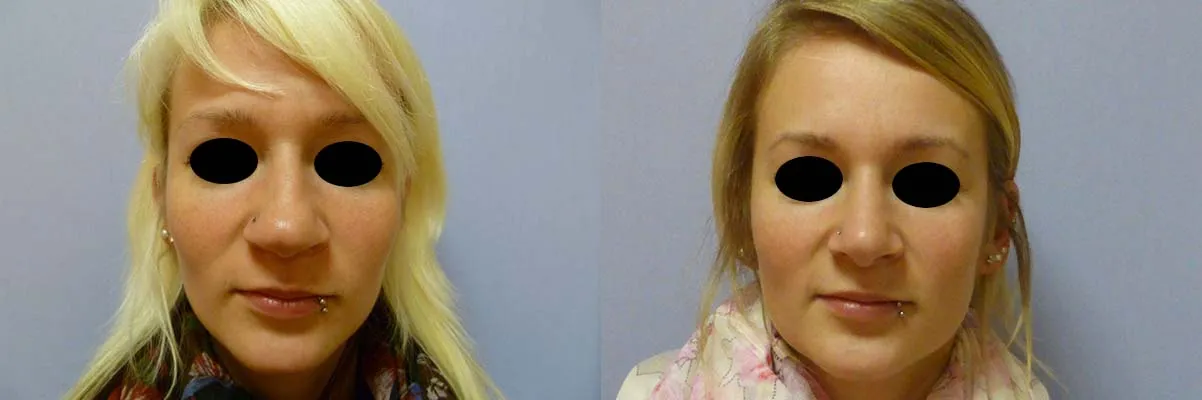 Корекція носа – Ринопластика – результат 12