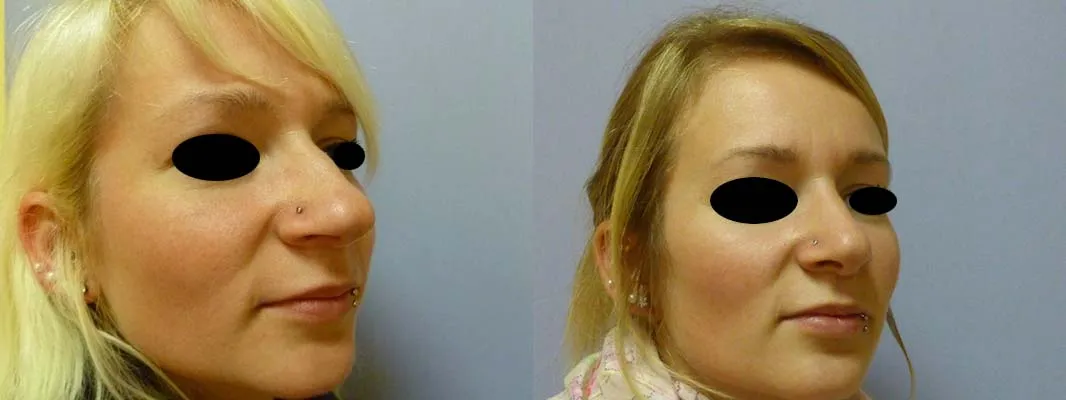 Корекція носа – Ринопластика – результат 13