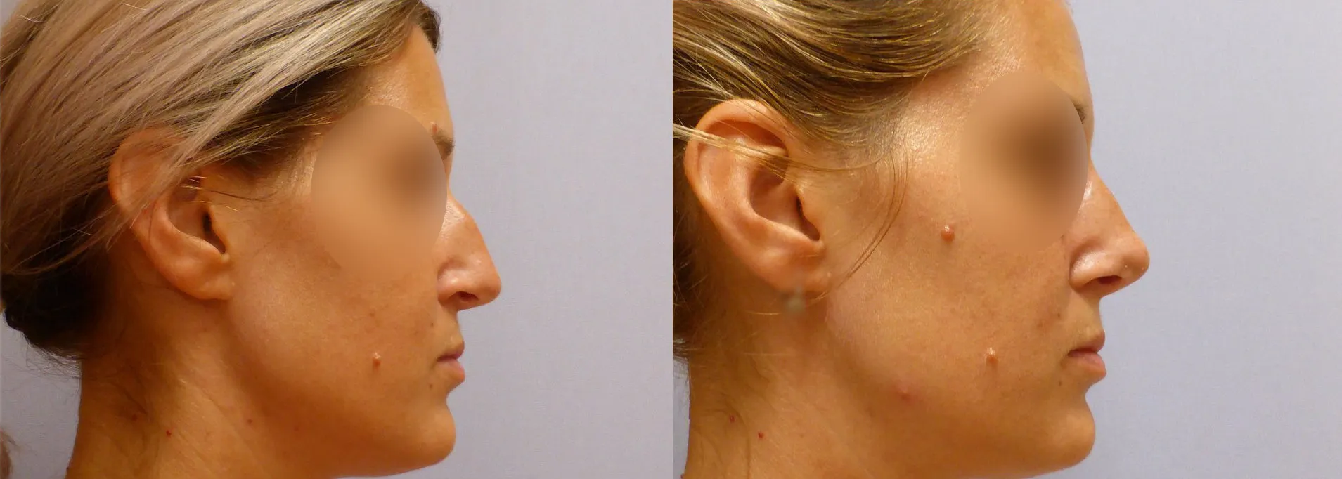 Корекція носа (Ринопластика) – результат 5