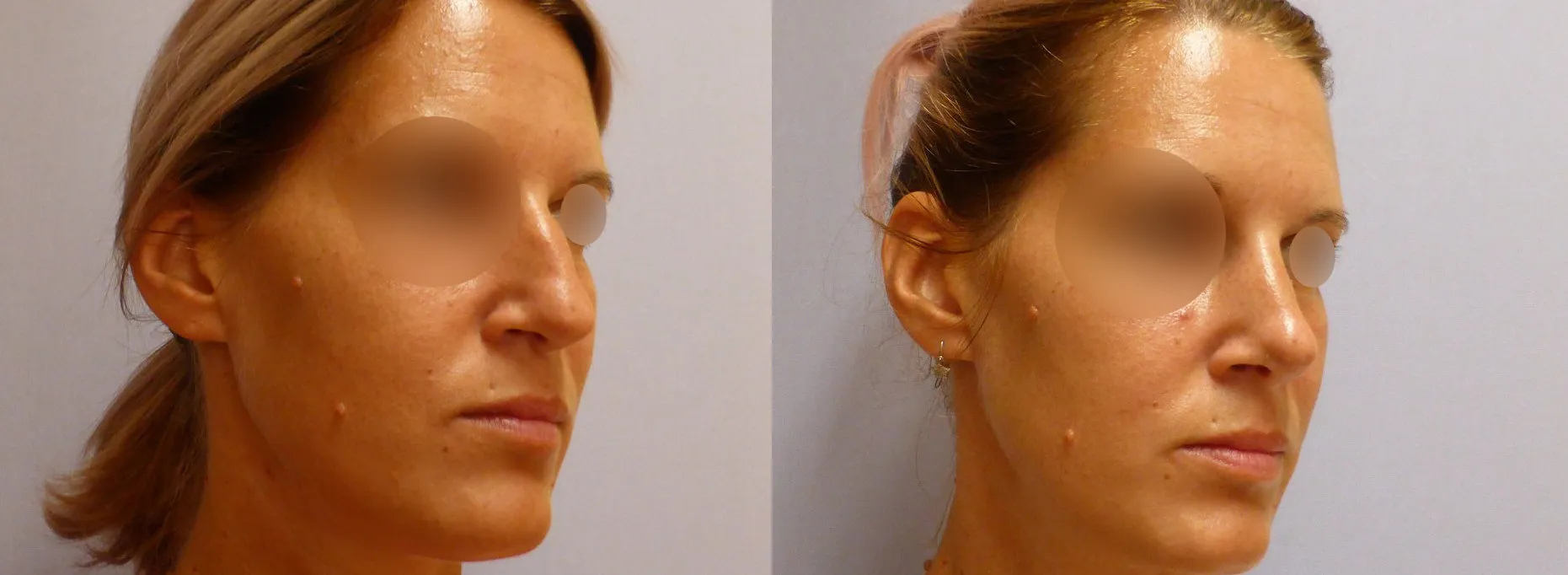 Корекція носа – Ринопластика – результат 15