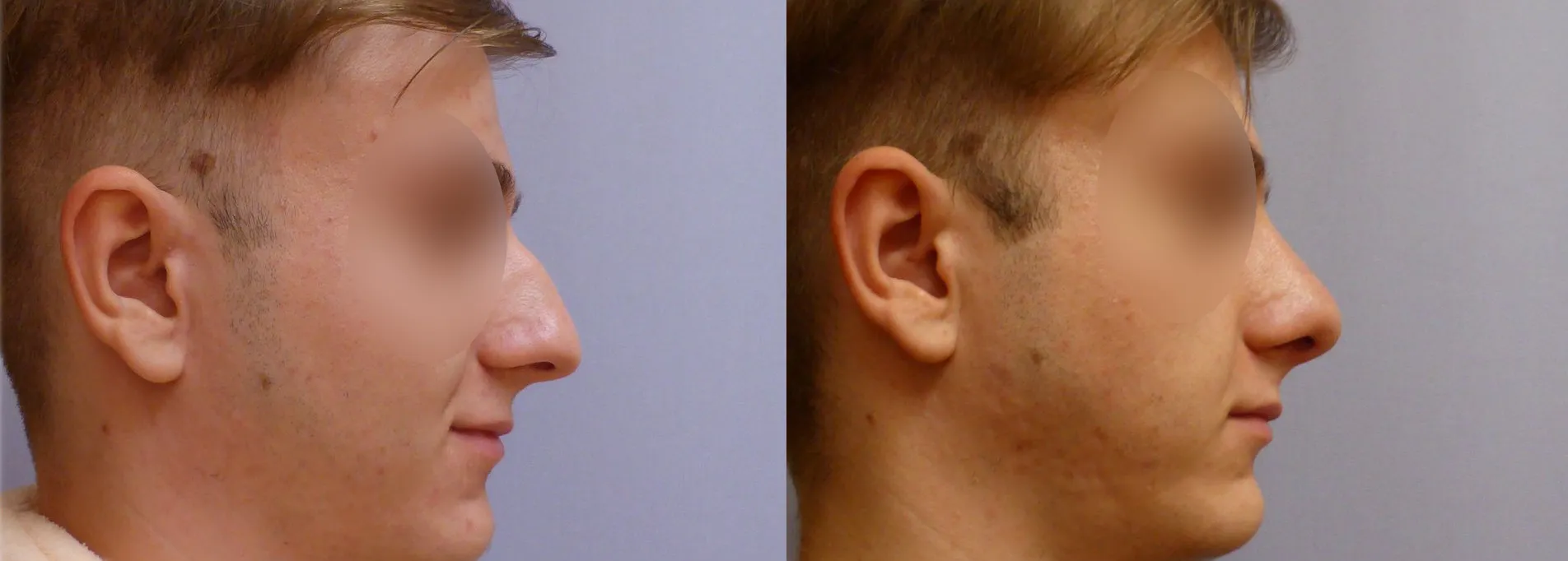 Корекція носа – Ринопластика – результат 16