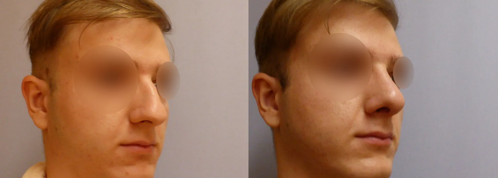 Корекція носа – Ринопластика – результат 17