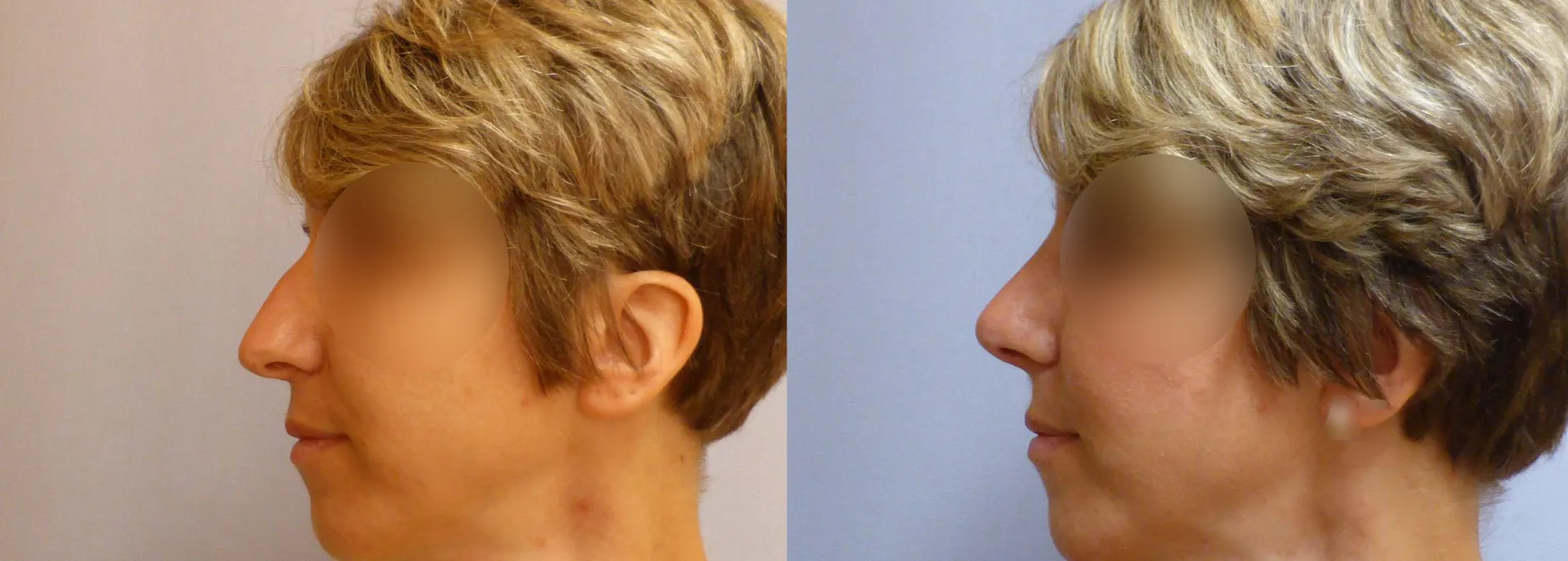 Корекція носа (Ринопластика) – результат 6