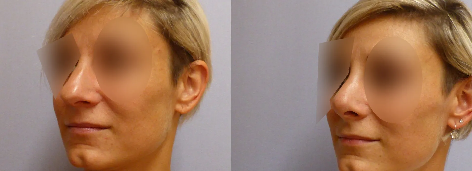 Корекція носа – Ринопластика – результат 20