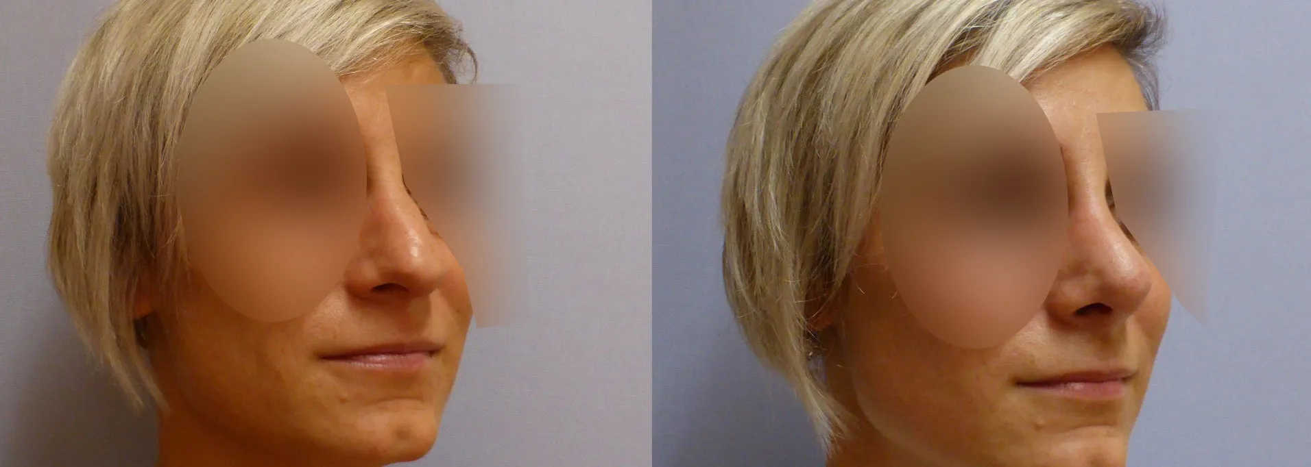 Корекція носа – Ринопластика – результат 21