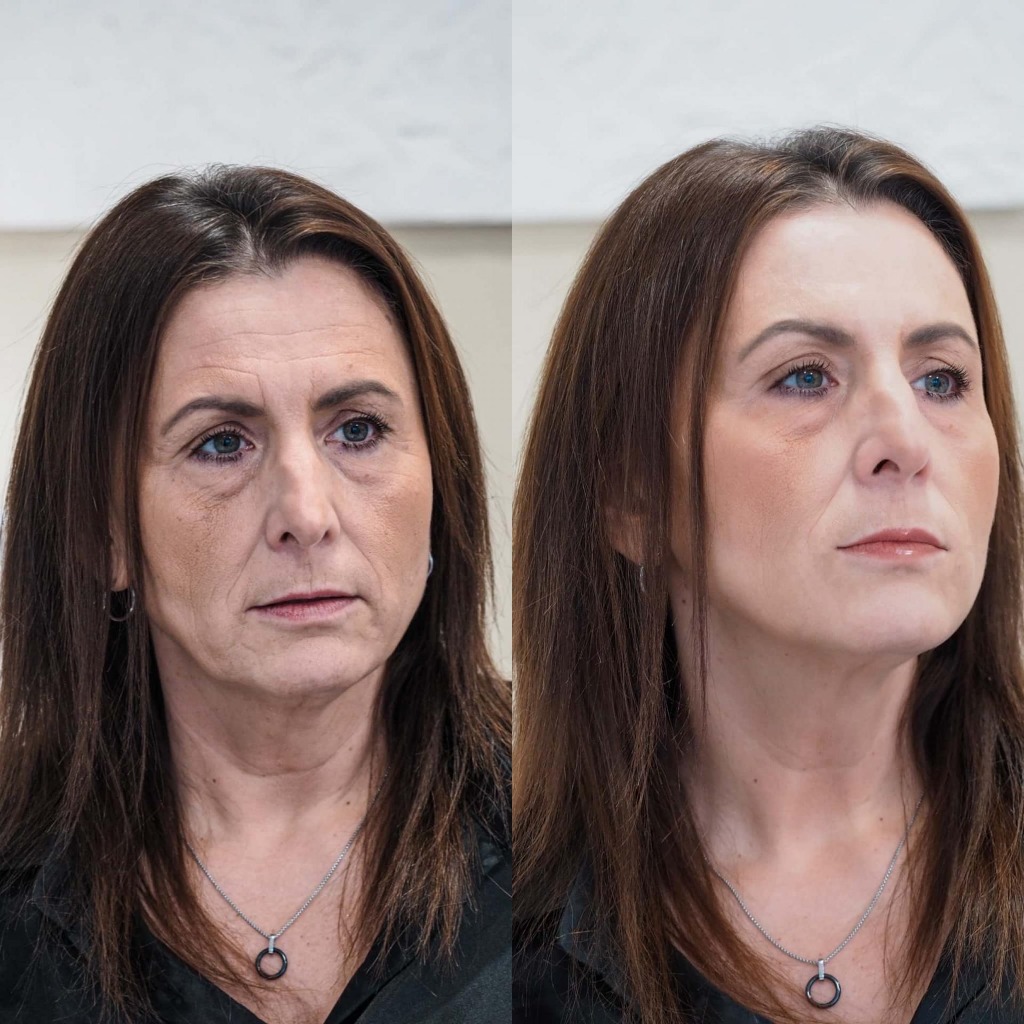 Kyselina hyaluronová