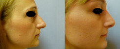 Rhinoplastika