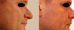 Rhinoplastika