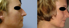 Rhinoplastika